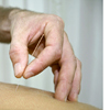 Bei einem Patienten wird eine Akupunktur durchgeführt
